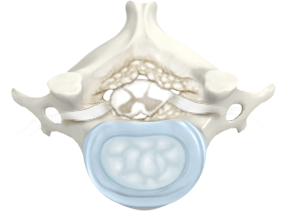 Clevive™ Degenerative Disc Disease Cushion