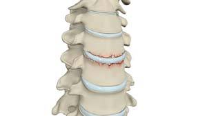 Cervical Fractures