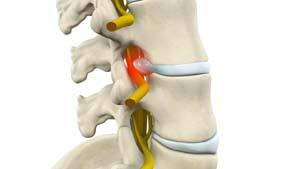 lumbar-radiculopathy