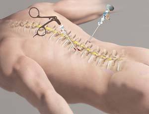 Minimally Invasive Spine Surgery (MISS)