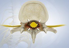 Spinal Stenosis