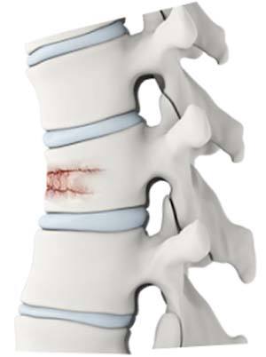 Vertebral Compression Fracture