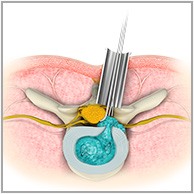 Minimally Invasive Spine Surgery (MISS)