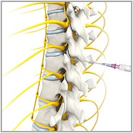 Spinal Injections